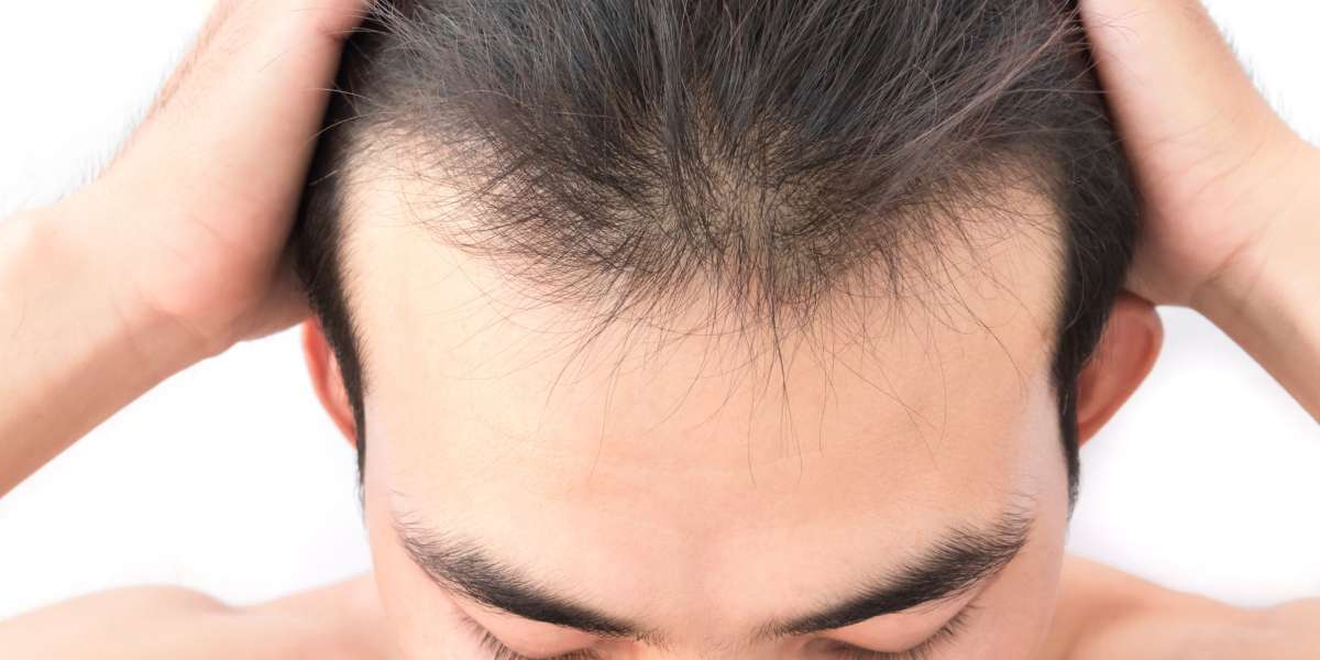 Why Hair Loss Solutions Are Becoming Popular Worldwide